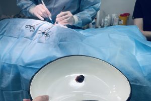 вырезанная опухоль